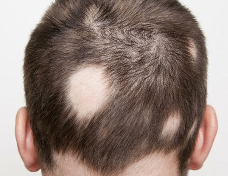 Rụng tóc ở nam giới: Nguyên nhân và cách khắc phục hiệu quả