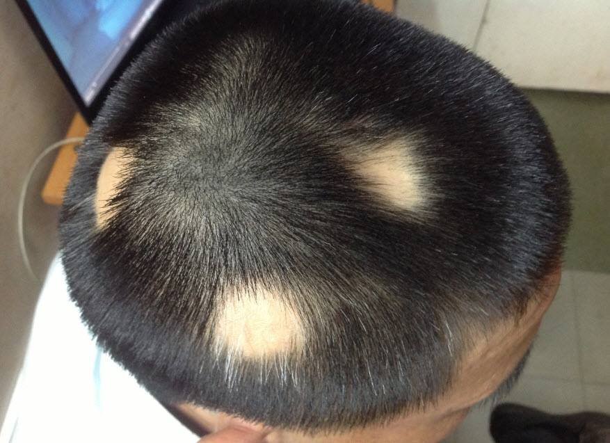 Các nguyên nhân gây rụng tóc từng mảng (alopecia areata)