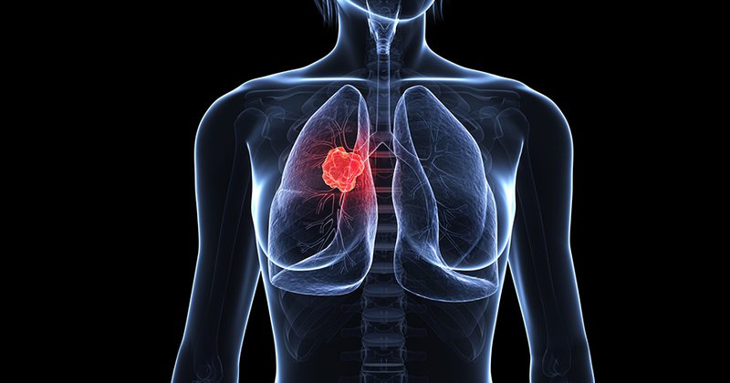đột biến gen trong ung thư phổi