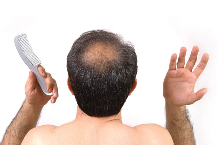 Rụng tóc nội tiết tố androgen có thể gặp ở nam giới