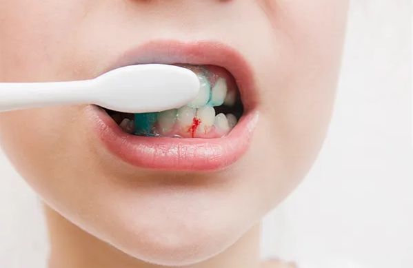 Có nhiều nguyên nhân khác nhau gây chảy máu nướu răng