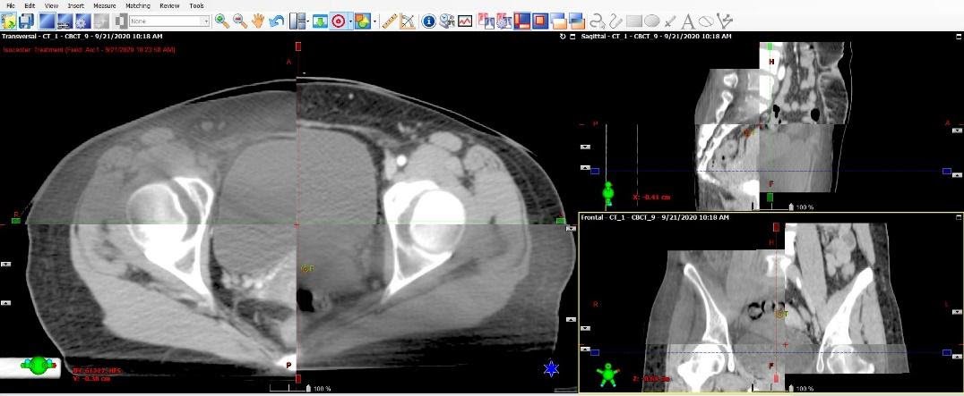 Đánh giá sự tái lập vị trí trên hình ảnh 3D-CBCT với hình ảnh CT scans trước điều trị