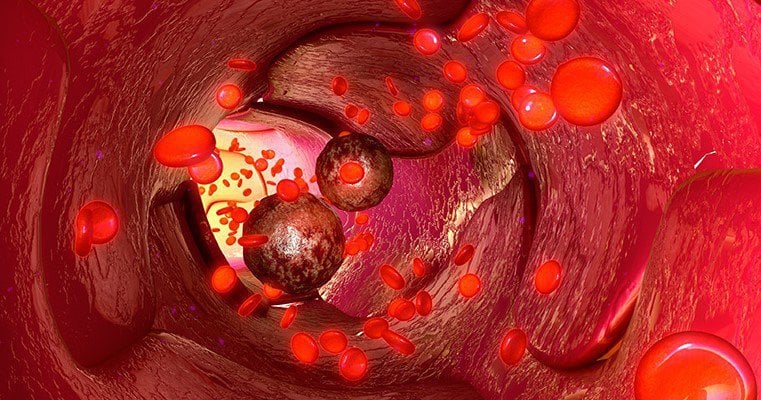 ghép tế bào gốc tạo máu