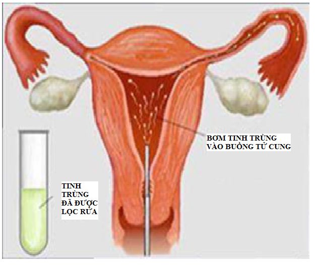 Tắc vòi trứng trái có thể bơm tinh trùng vào buồng tử cung được không?