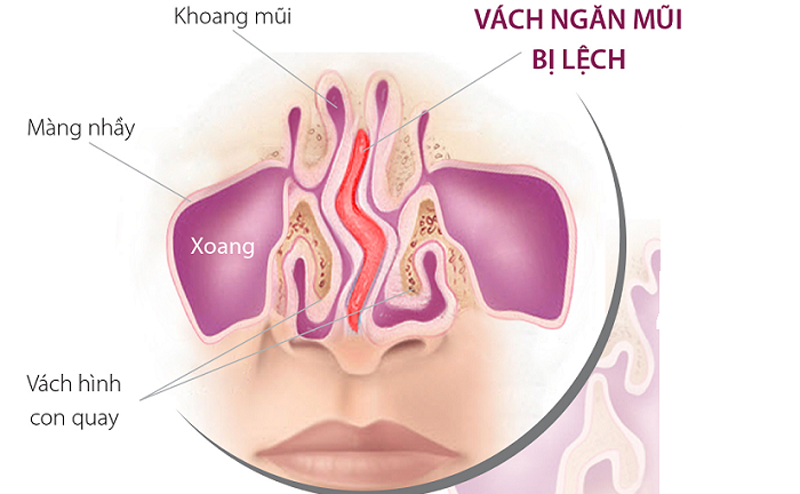 Cách điều trị lệch phần cánh mũi kèm viêm xoang mũi gây khó thở?