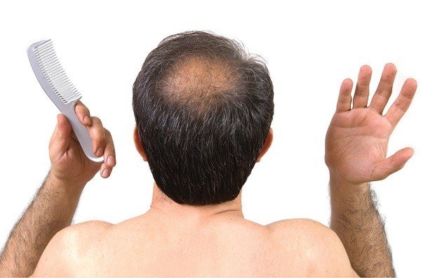 Các nguyên nhân gây rụng tóc từng mảng (alopecia areata) | Vinmec