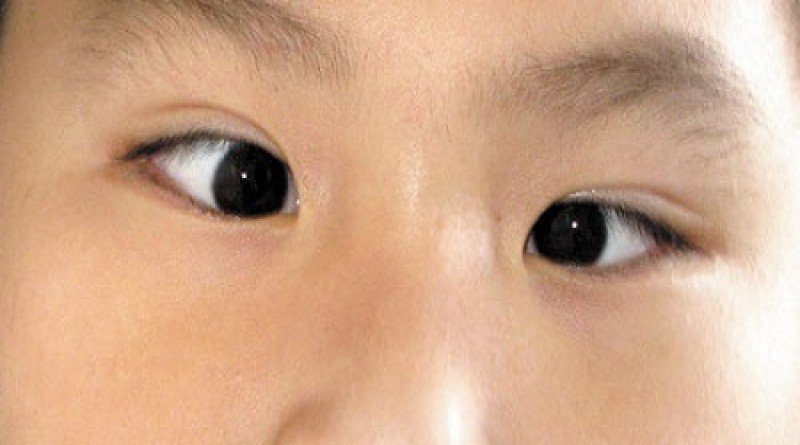 Trẻ nhìn một thành hai sau mổ mắt lác có nguy hiểm không?