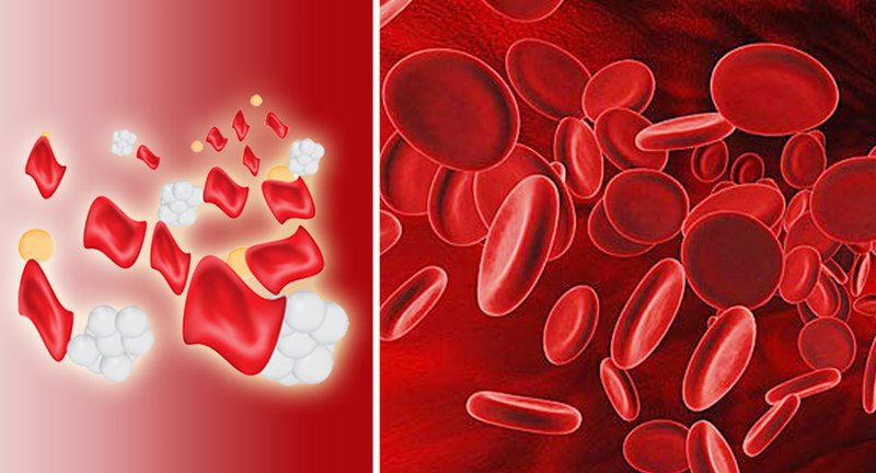 bệnh thiếu máu di truyền thalassemia