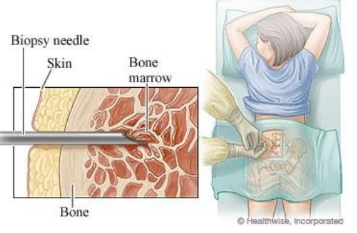 Hình minh họa: Sinh thiết tủy xương và chọc hút tủy xương