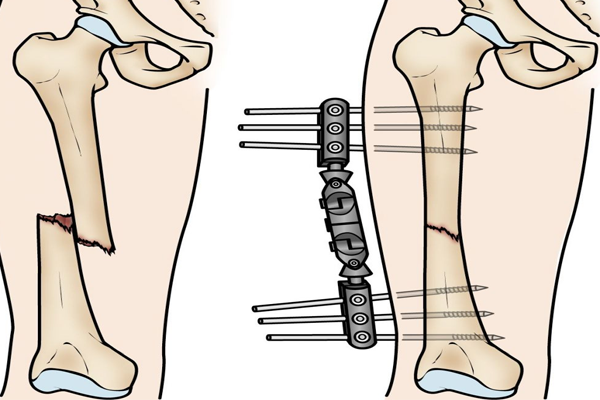 Một chân bị ngắn lại sau gãy xương đùi khắc phục được không?
