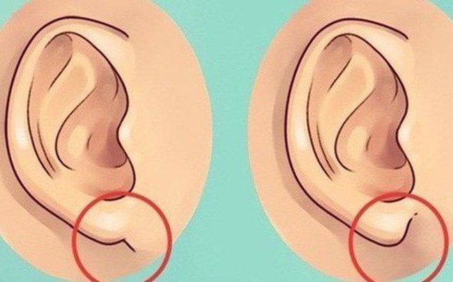 Dái tai bị sưng: Hình ảnh, nguyên nhân và cách điều trị
