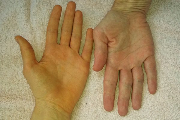 Vàng da bàn tay, bàn chân vào mùa đông là dấu hiệu bệnh gì?