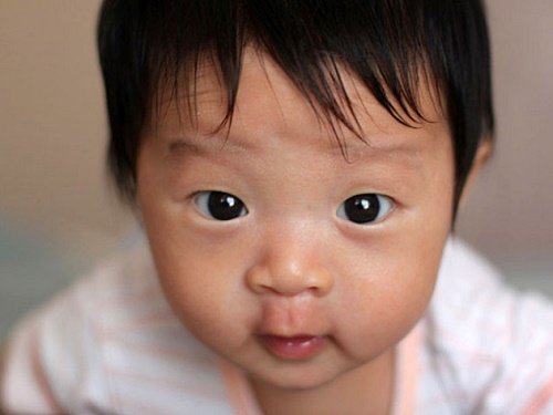 Trẻ 5 tháng tuổi mắt bị lác vào trong có chữa được không?