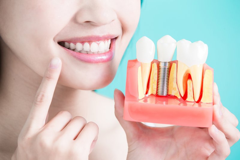Gắn răng implant có khắc phục được tình trạng má bị hóp không?