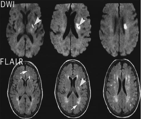 Chụp MRI não có thể hiện tổn thương chất trắng não không?