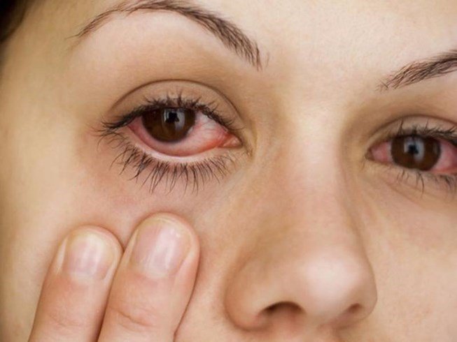 Bệnh mắt xuất huyết võng mạc PCV có nên mổ không?