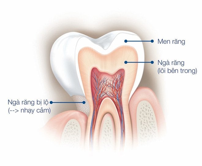 Hình ảnh mô phỏng ngà răng và ngà răng bị hở