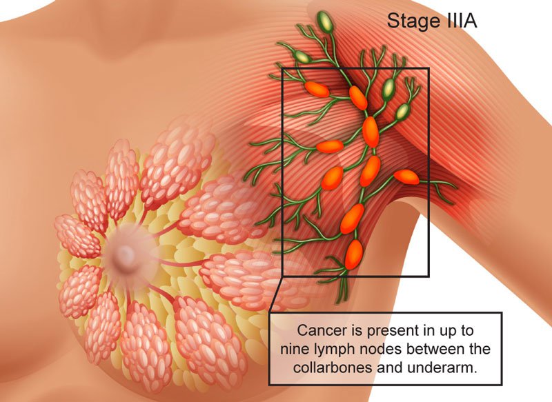 Viêm xơ tuyến vú và mọc hạch ở nách có phải bị ung thư không?
