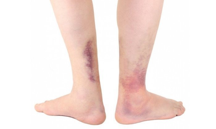 Trẻ 5 tuổi xuất hiện vết bầm tím không đau ở chân là bệnh gì?