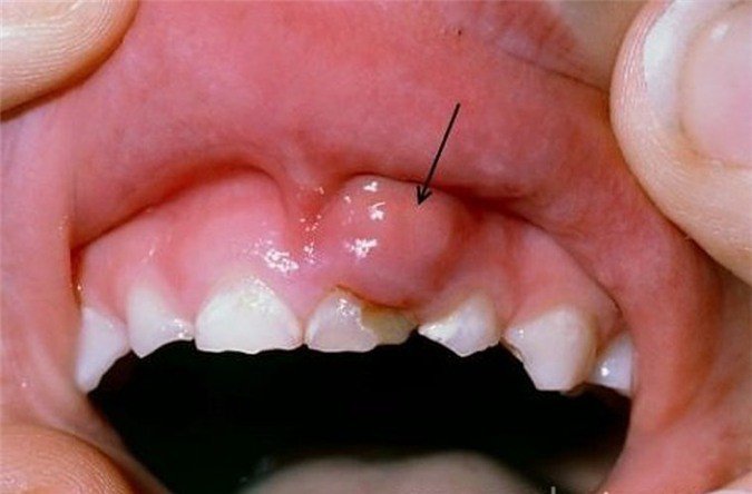 u răng phức hợp