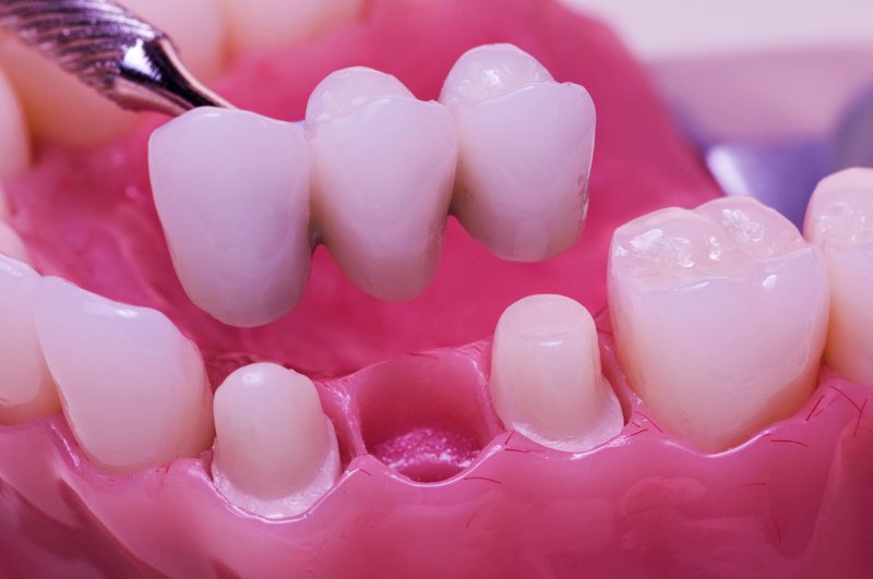Cầu răng là gì và khi nào sử dụng?