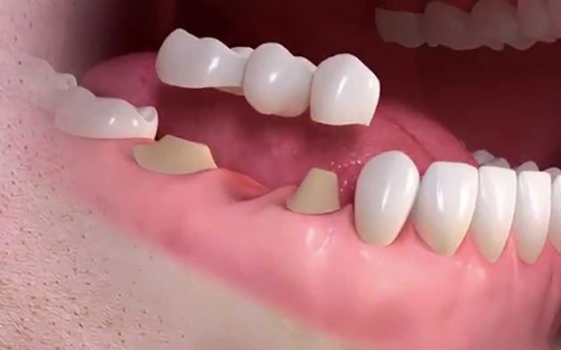 Cầu răng là gì