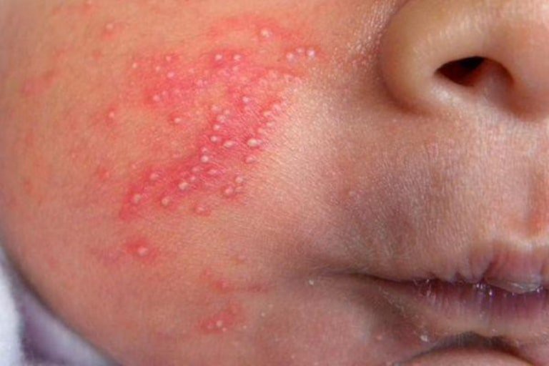 Hình ảnh nhiễm khuẩn da tụ cầu ở trẻ em