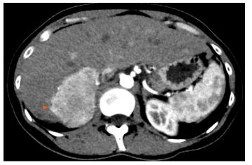 Angiomyolipoma ở một phụ nữ 33 tuổi khỏe mạnh: Chụp cắt lớp vi tính ổ bụng trên pha động mạch cho thấy một khối u đặc tăng mạch khu trú ở đoạn sau bên phải (đầu mũi tên).