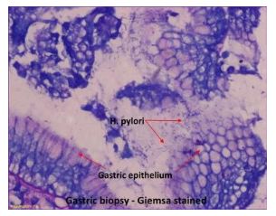 Biểu mô dạ dày và vi khuẩn H.Pylori