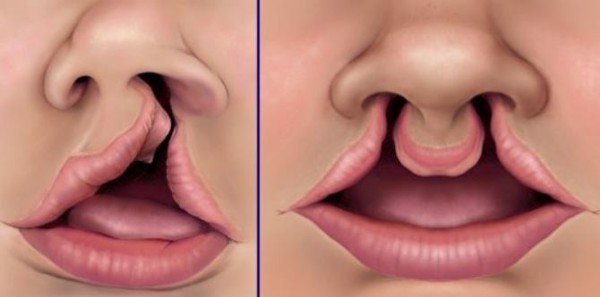 Trẻ sơ sinh bị sứt môi một bên bao lâu có thể phẫu thuật được?