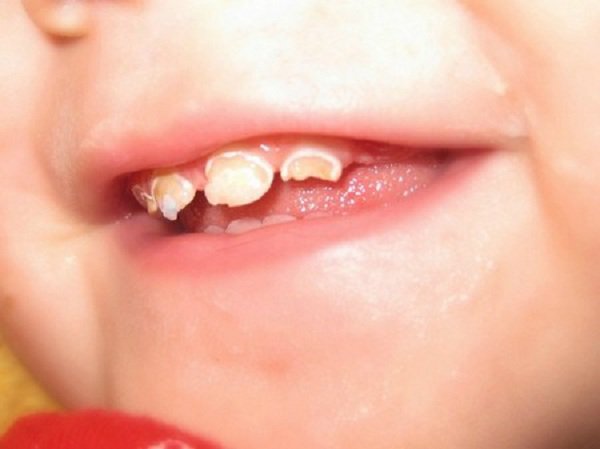 Bé 1 tuổi bị mòn men răng phải làm sao?