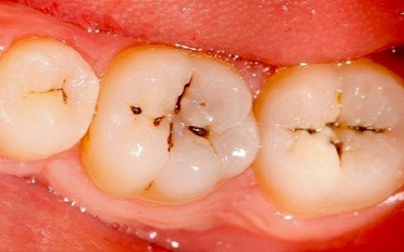 Bà bầu có điều trị sâu răng được không?