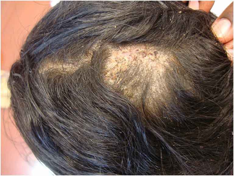 Xịt tóc thảo dược Lan Chi hỗ trợ trị rụng tóc, nấm, ngứa da đầu