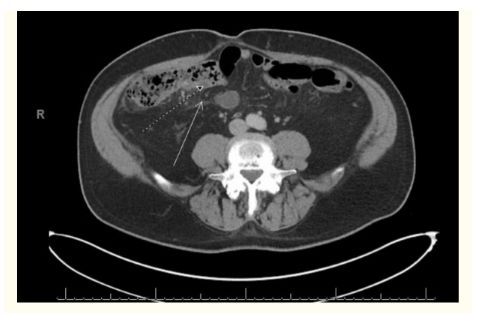 CT bụng và khung chậu có cản quang (nhìn dọc trục) cho thấy sự thay đổi viêm đáng kể ở vùng hạ sườn phải ở mạc treo tràng bao quanh manh tràng (mũi tên trắng) và dày thành manh tràng (mũi tên chấm).