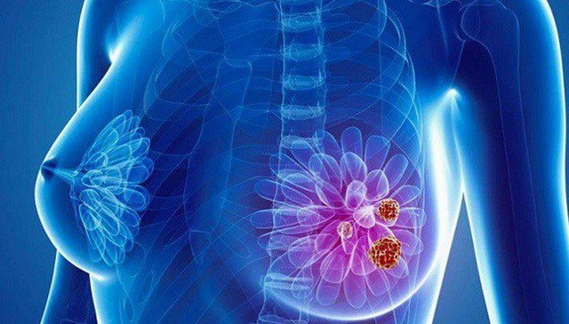 Điều trị ung thư vú giai đoạn 4, bướu độc liệu mô như nào?