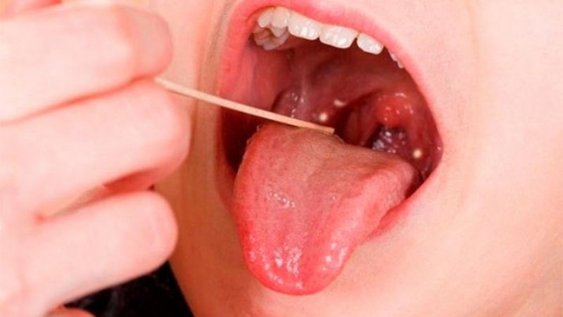 Đau họng kéo dài là biểu hiện của bệnh gì?