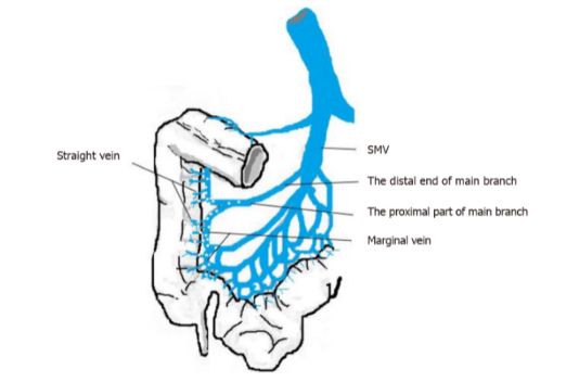 Minh  họa bằng đồ thị về sự phân bố vôi hóa trong tĩnh mạch mạc treo tràng trên. SMV: Tĩnh mạch mạc treo tràng trên.