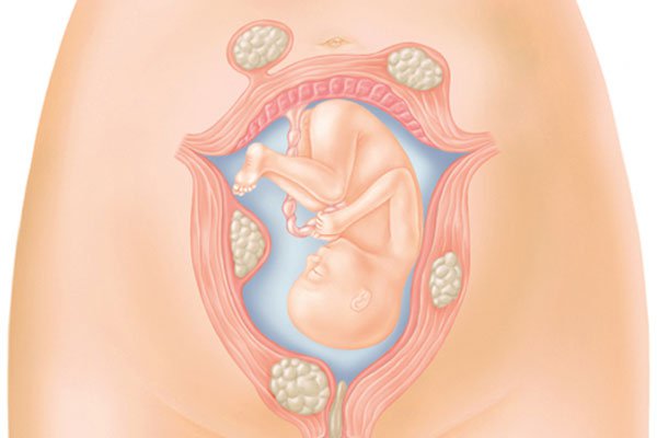 Người bệnh u xơ tử cung khi mang thai có nguy hiểm không?