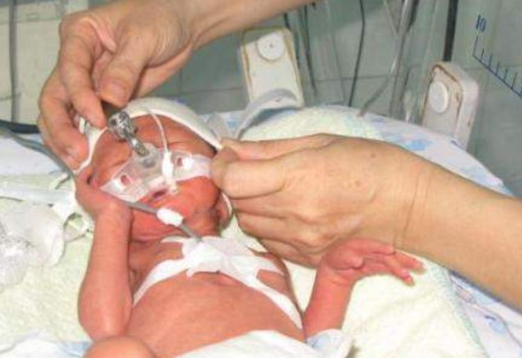 Trẻ sơ sinh có thể bị suy hô hấp do bệnh màng trong