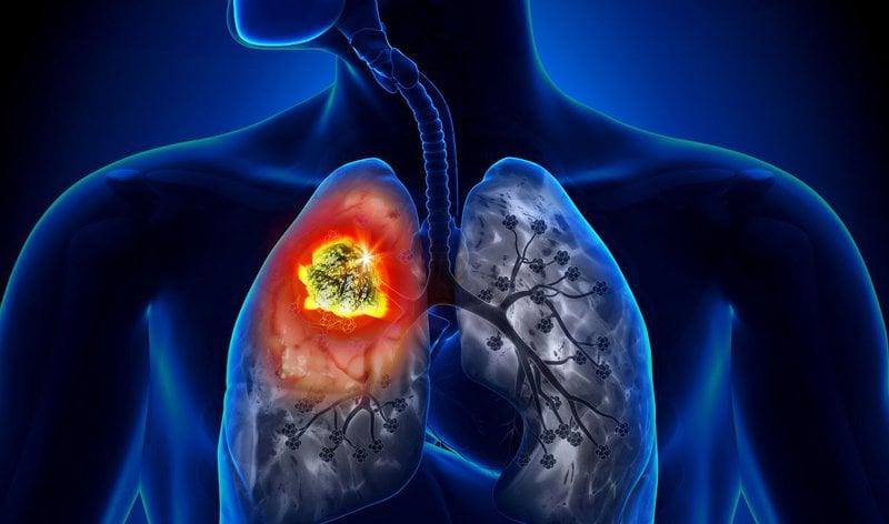 Ung thư phổi di căn