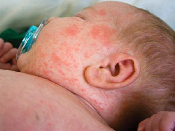 Trẻ bị sốt phát ban sau khi tiêm vacxin 5in1 có sao không?
