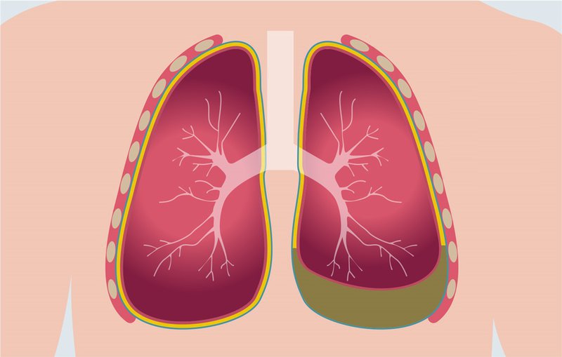 Điều trị ổ cặn màng phổi không phẫu thuật như thế nào?
