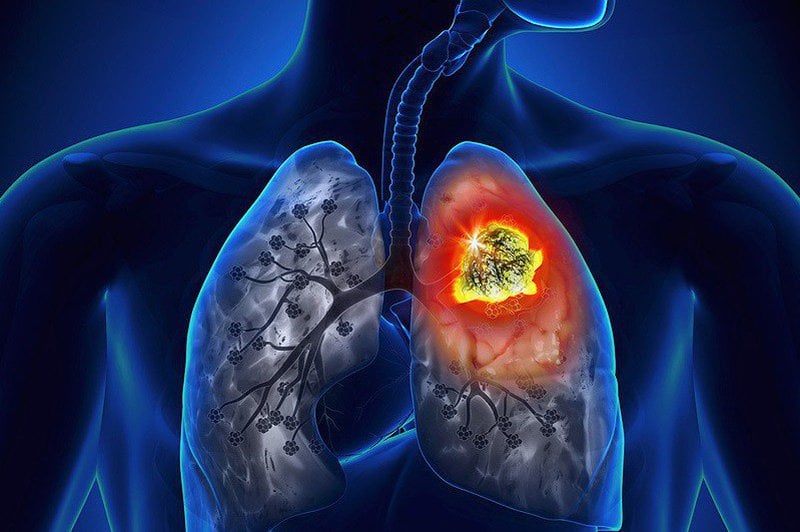 Ung thư phổi giai đoạn cuối