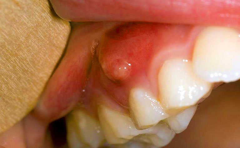 Cục mủ nhỏ dưới nướu chân răng là dấu hiệu của bệnh gì?