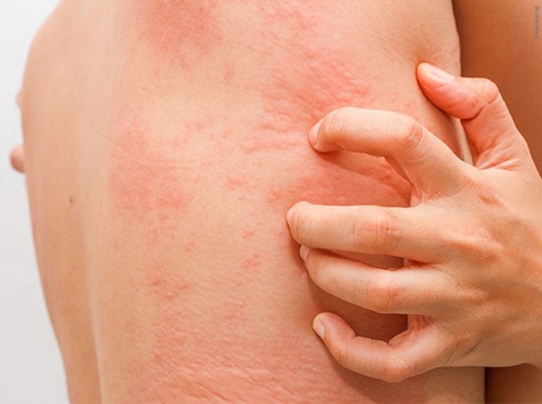 Nổi sần ngứa trên da là dấu hiệu của bệnh gì?