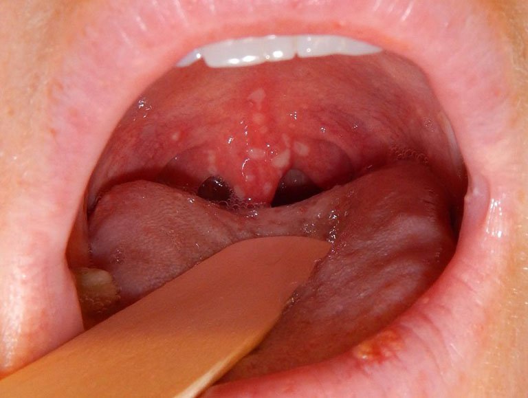 Trẻ bị viêm loét trong miệng là do bệnh gì?