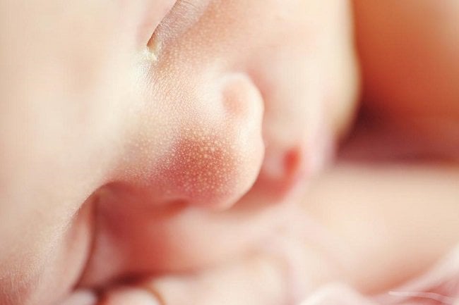 Trẻ 3 tuần tuổi nổi mụn li ti trên mặt có nguy hiểm không?