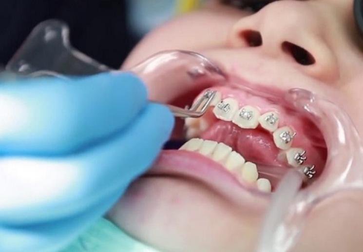 Răng bị lệch sau khi niềng răng có sao không?