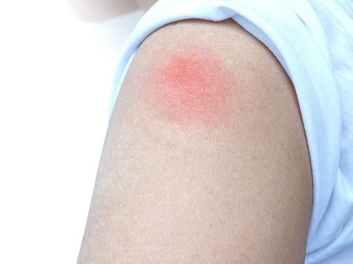 Phản ứng cánh tay sau tiêm vắc xin Covid 19