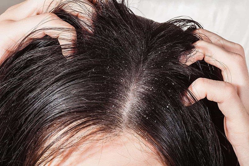 Ngứa da đầu, có vảy trắng, rụng tóc là biểu hiện của bệnh lý gì?